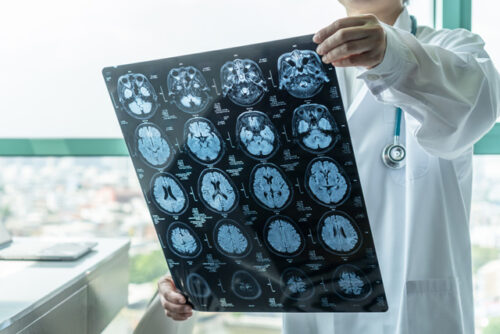 Brain disease misdiagnosis