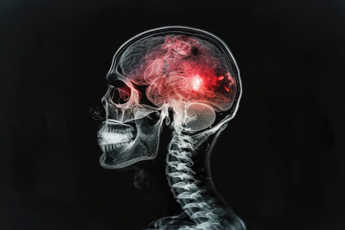 X ray of a man. Brain damage